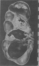 肾压迫萎缩肾盂乳头状瘤,引起肾盂积水进而压迫肾实质引起萎缩