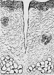 创缘整齐,组织破坏少