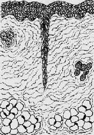 表皮再生,少量肉芽组织从伤口缘长入