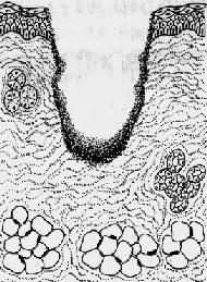 创口大,创缘不整,组织破坏多