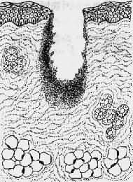伤口收缩,炎症反应重