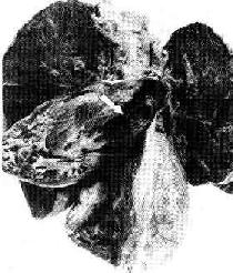 肺动脉血栓栓塞(箭头示)