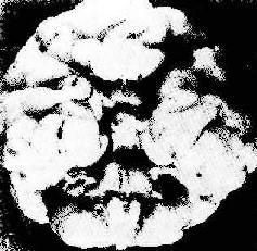 三体(Patau)综合征脑畸形