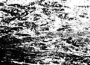 恶性肿瘤的浸润性生长(食管鳞状细胞癌)