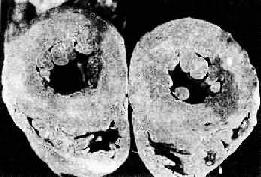 高血压病时左心室向心性肥大(心脏横断面)