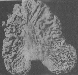早期胃癌(表浅隆起型Ⅱa)