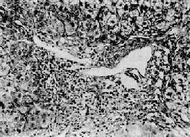 慢性活动性肝炎