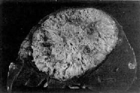 原发性肝癌(巨块型)