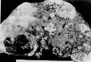 原发性肝癌(结节型)