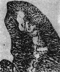 膀胱移行细胞癌 Ⅰ级