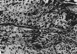 膀胱移行细胞癌 Ⅱ级