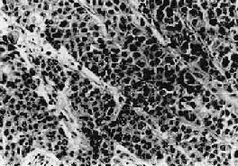 膀胱移行细胞癌 Ⅲ级