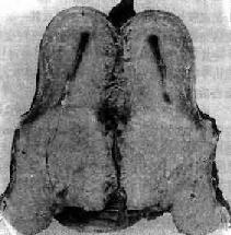 子宫颈癌(内生浸润型)