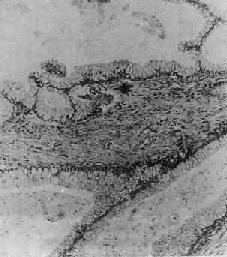 卵巢粘液性囊腺瘤