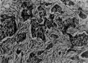 浸润性导管癌(单纯癌)