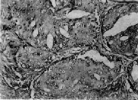 前列腺癌(低分化型)