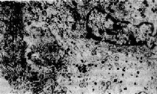 催乳素细胞腺瘤(电镜)