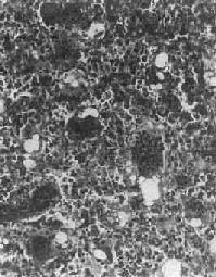 骨巨细胞瘤(Ⅰ级)