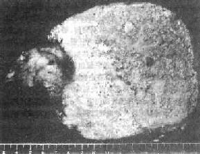 肝泡状棘球蚴病(巨块型)