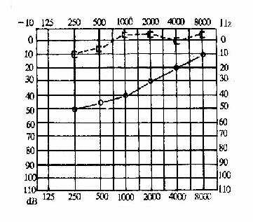 传导性聋(右耳)