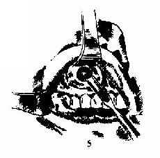 上颌窦根治术 5.暴露尖牙窝,凿开前壁骨质