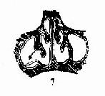 上颌窦根治术 7. 凿开上颌窦内侧壁骨质,形成下鼻道对孔