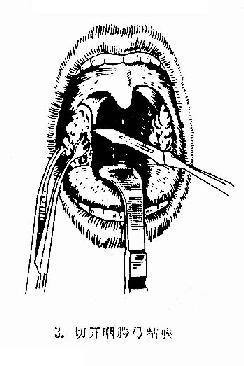 扁桃体切除术(剥离法)