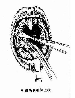 扁桃体切除术(剥离法)
