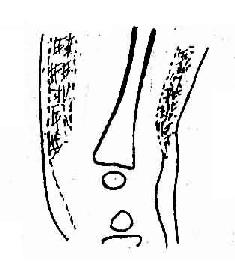 急性血源性化脓性骨髓炎,早期,软组织肿胀