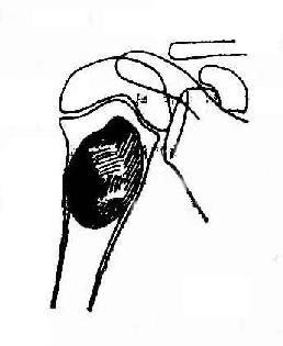 肱骨干骺端单房性骨囊肿,轻度膨胀,皮质变薄