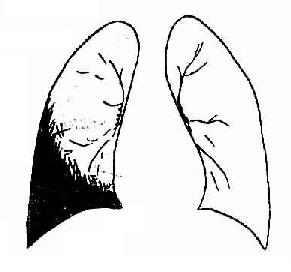 右侧中等量积液,上缘呈典型的弧形