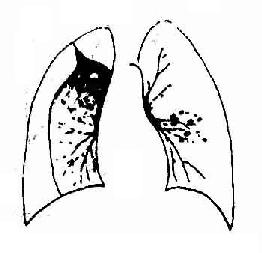 右侧气胸,右肺外上与胸侧壁有粘连