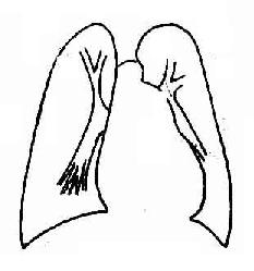 房间隔缺损,并发肺循环高压