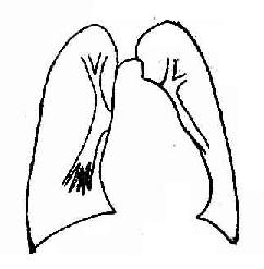 动脉导管未闭症,并发肺循环高压