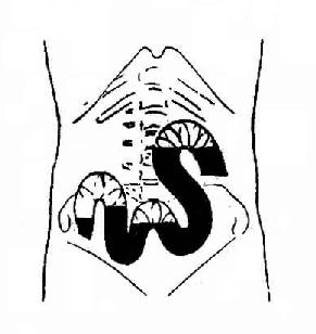 小肠梗阻(立位)