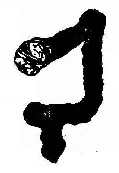 结肠肠套迭,钡灌肠的杯口状梗阻及弹簧状钡纹