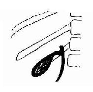 静脉法胆囊造影,胆囊呈层状显影