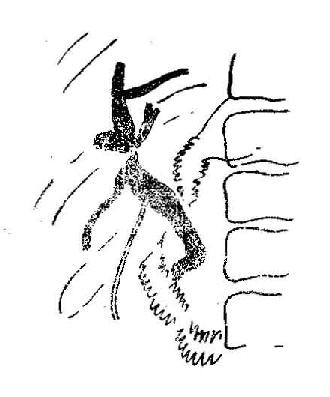 术后胆管造影,示胆管不规则狭窄与扩张