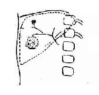 肝海绵状血管瘤(动脉期)