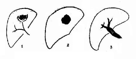 肝癌(肝动脉造影示意图)