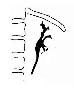 左肾实质癌左肾中、下盏受压移位,下盏有破坏