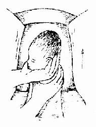 左手助儿头旋转及娩出前肩,右手保护会阴