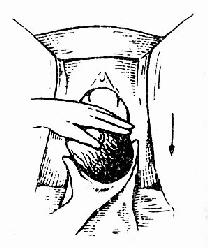 娩出后肩,注意保护会阴