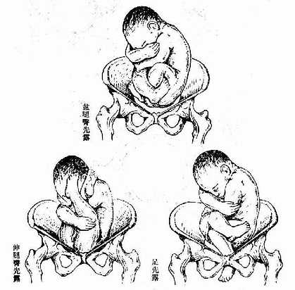 臀位,均为骶左后