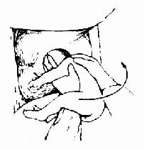 上举儿身,娩出儿头(左手食、中二指分置两侧颊部)