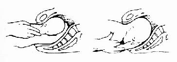 前举臂(右臂)娩出侧面示意图