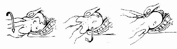 后举臂(左臂)娩出示意图