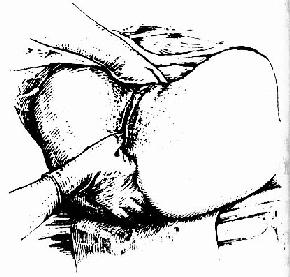 川合诊(拇、食指)