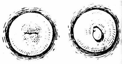 宫颈糜烂(左)与息肉(右)