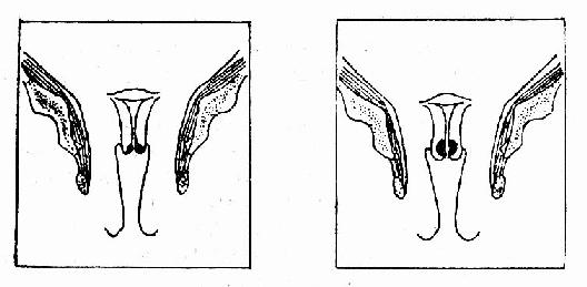 临床Ⅰ期癌 ,冠状剖面示意图